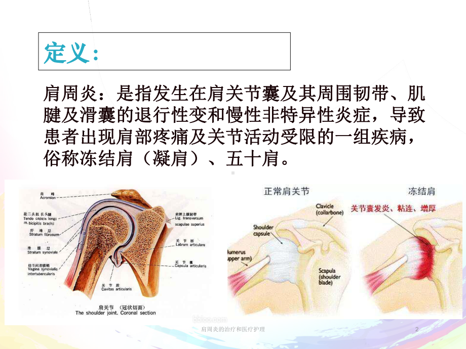 肩周炎的治疗和医疗护理培训课件.ppt_第2页