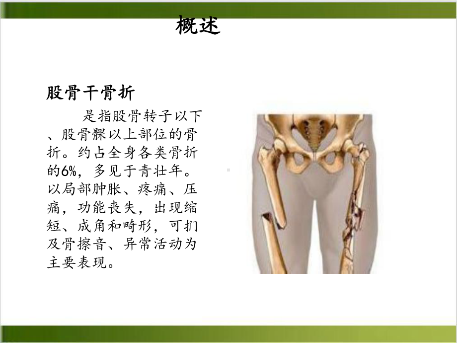 股骨干骨折教学查房优质案例课件.ppt_第3页