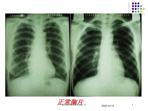 肺结核的影像诊疗X线汇总培训课件.ppt