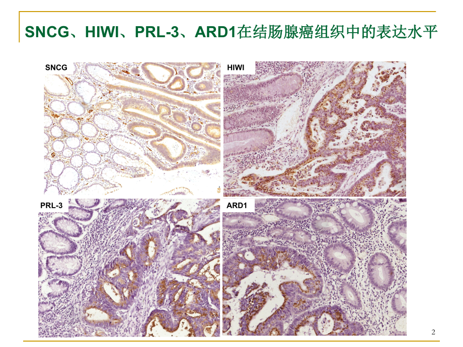 一组潜在肿瘤标志物在判断结肠癌病人预后中的作用课件.ppt_第2页