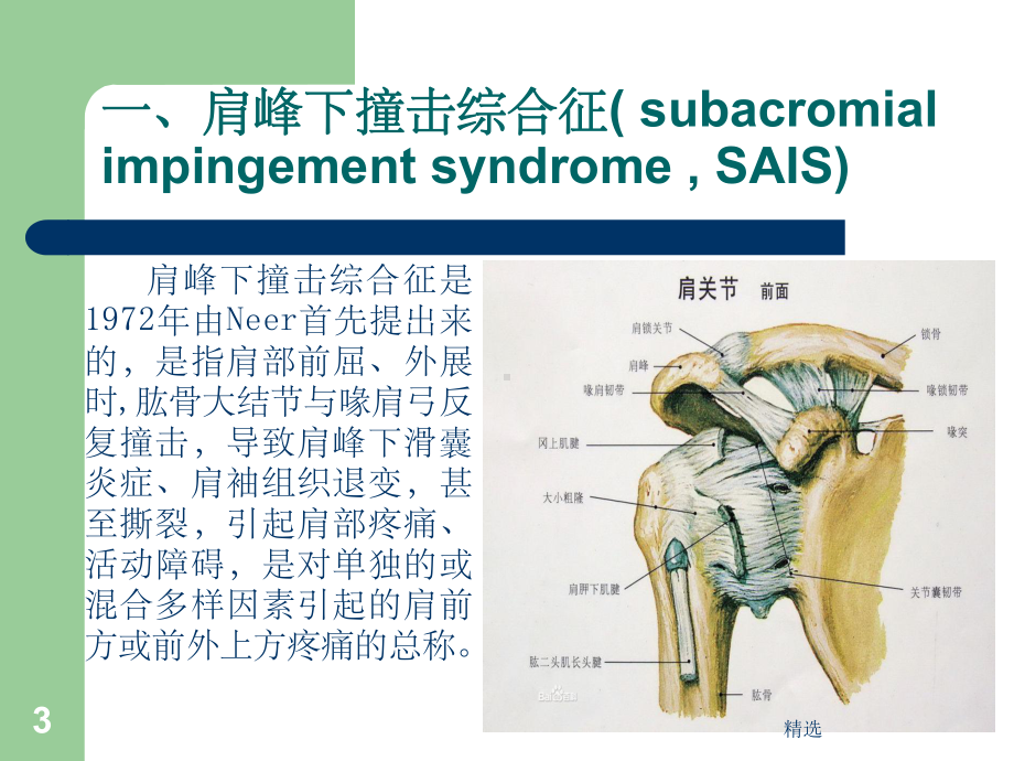 肩峰下撞击综合征课件.ppt_第3页