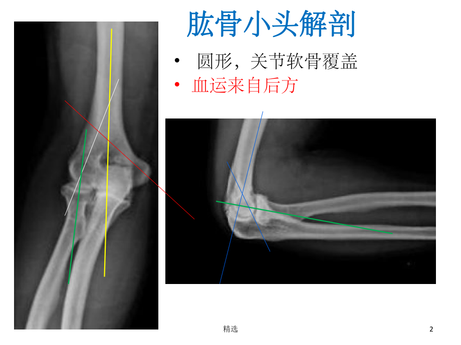 肱骨小头骨折的手术技巧课件-2.ppt_第2页