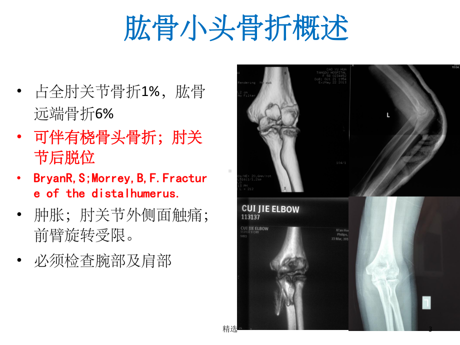 肱骨小头骨折的手术技巧课件-2.ppt_第3页