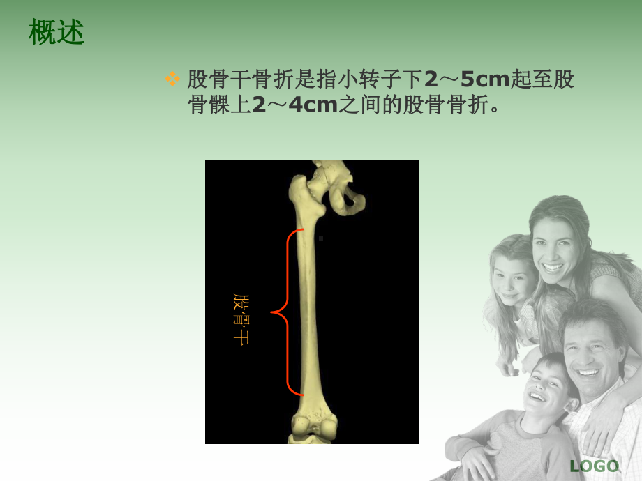 股骨干骨折的护理课件.pptx_第2页