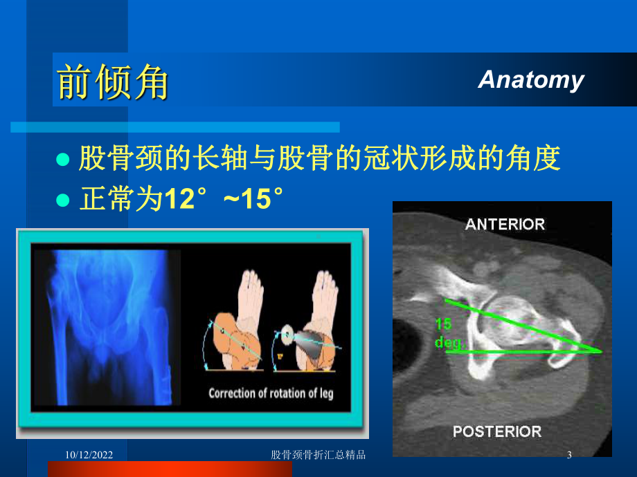 股骨颈骨折汇总培训课件-2.ppt_第3页