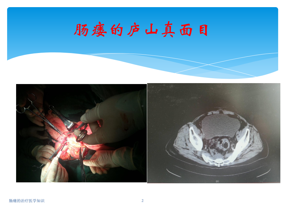 肠瘘的治疗医学知识培训课件.ppt_第2页