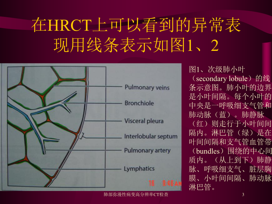 肺部弥漫性病变高分辨率CT检查培训课件.ppt_第3页