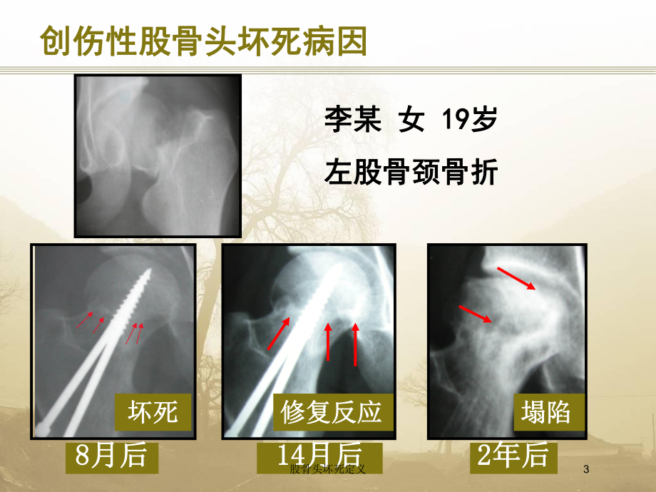 股骨头坏死定义培训课件.ppt_第3页