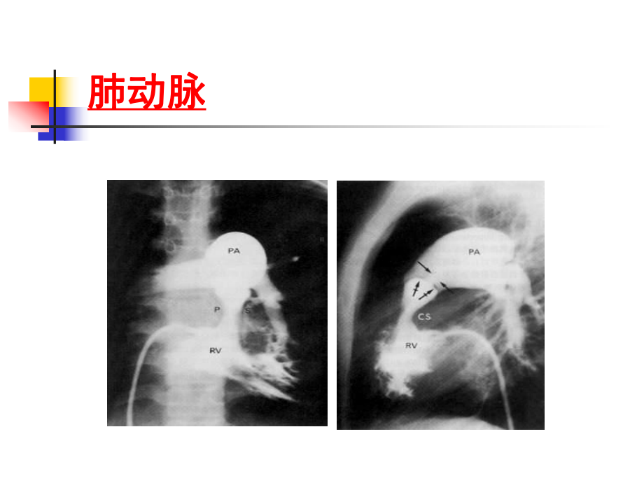 肺栓塞的CT讲义课件.ppt_第3页