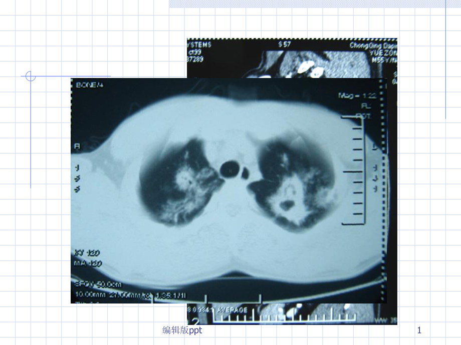 肺部CT及X线诊断基础课件.ppt_第1页