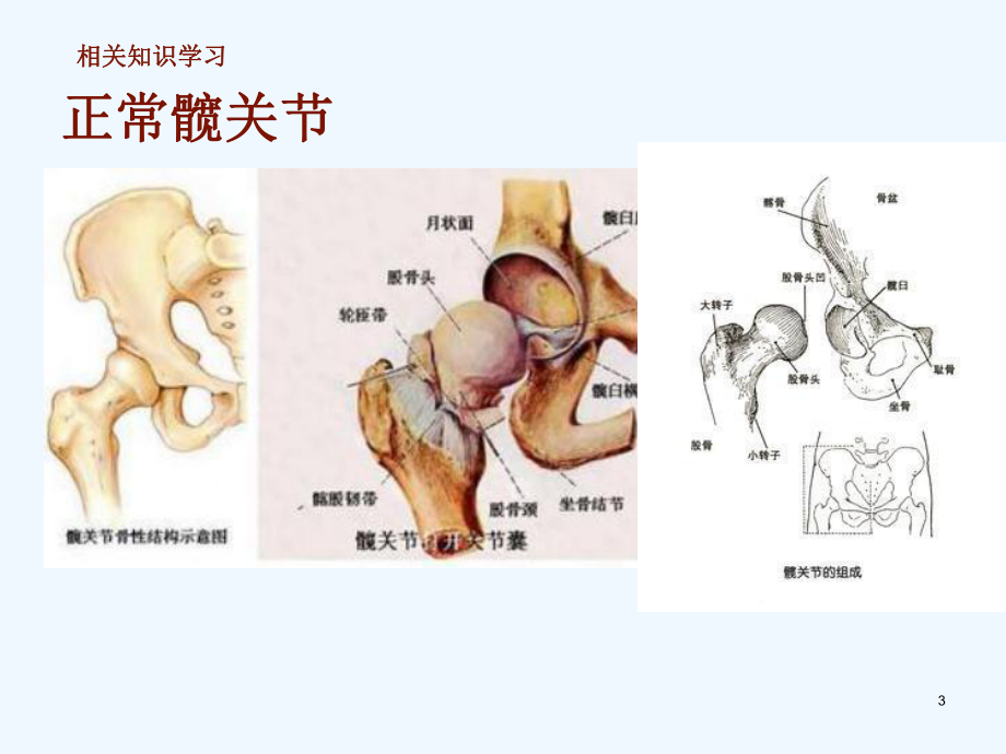 股骨干骨折骨科十病区课件.ppt_第3页