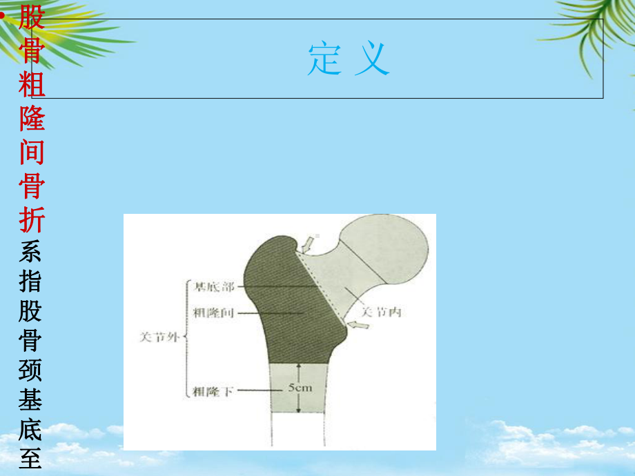 股骨粗隆间骨折术后护理查房最全课件.ppt_第2页