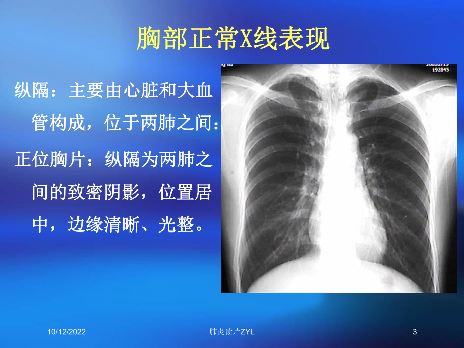 肺炎读片ZYL培训课件.ppt_第3页