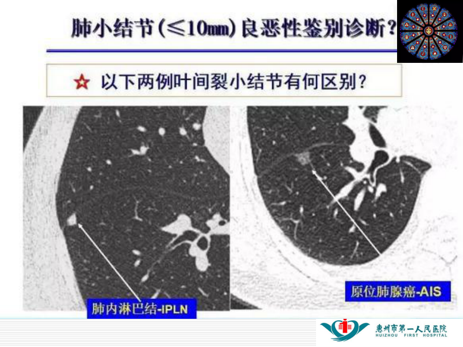 肺内淋巴结专业知识讲座培训课件.ppt_第2页