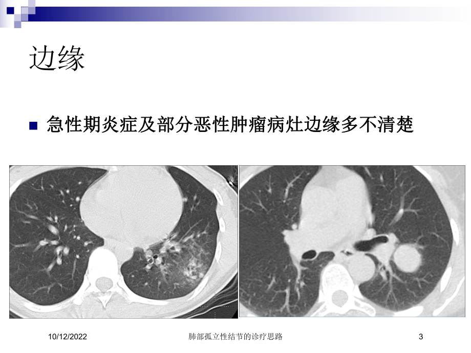 肺部孤立性结节的诊疗思路培训课件.ppt_第3页