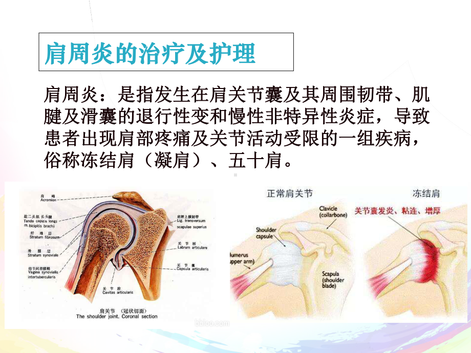 肩周炎的治疗及护理-课件.ppt_第2页