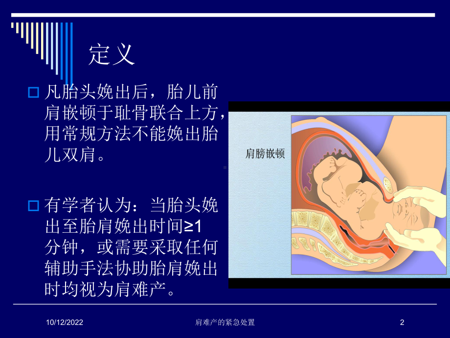 肩难产的紧急处置培训课件.ppt_第2页