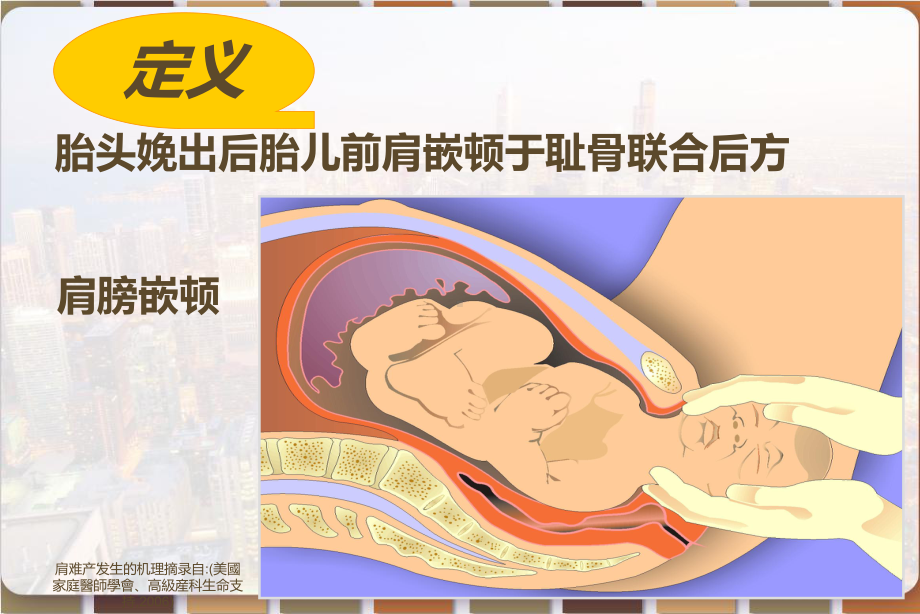 肩难产的临床护理及预防-课件.pptx_第2页