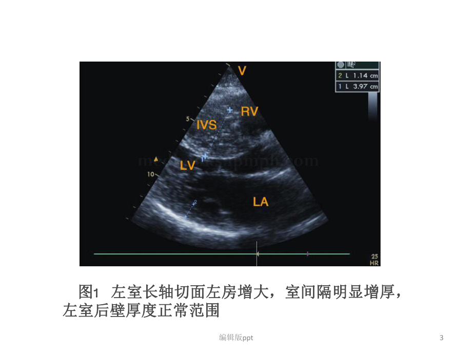 肥厚型心肌病课件.pptx_第3页