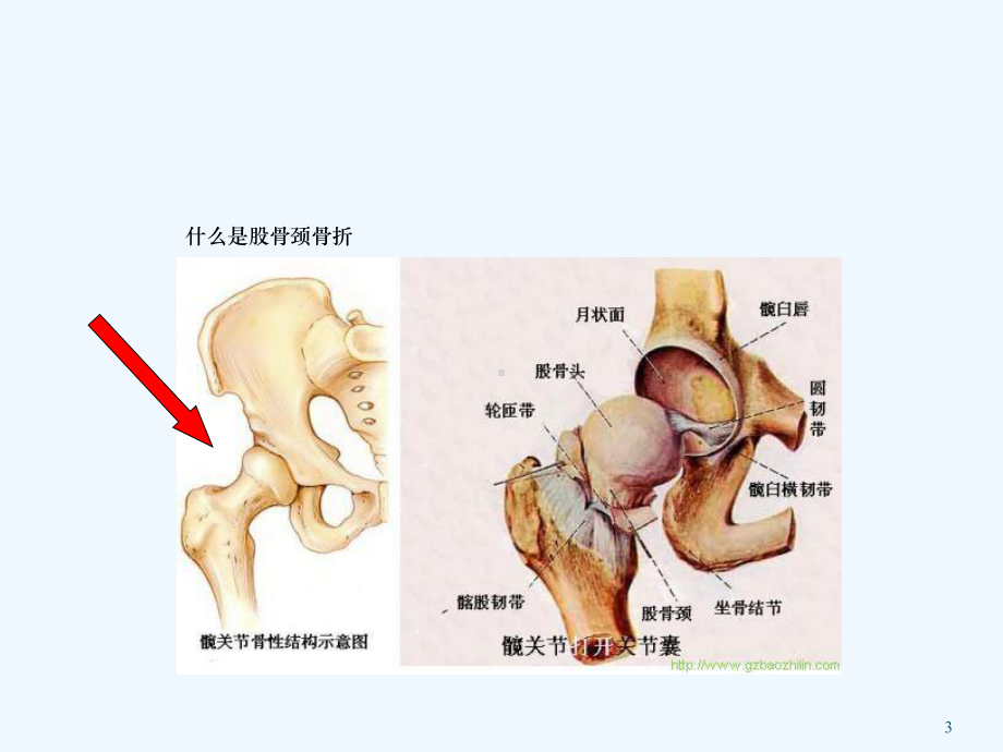 股骨颈骨折髋关节置换术护理课件.ppt_第3页