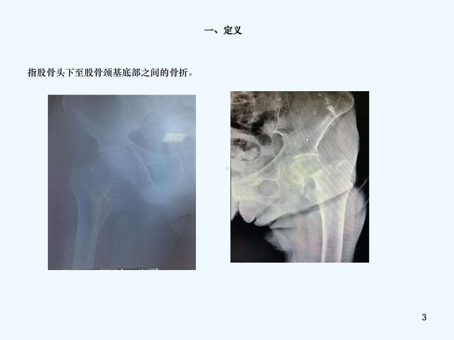 股骨胫骨折护理查房课件.ppt_第3页