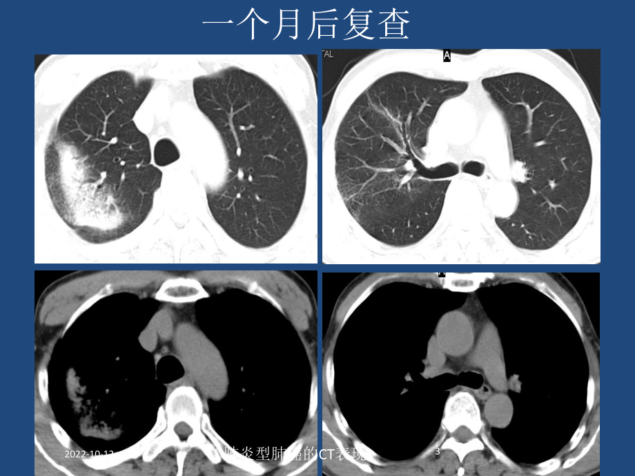 肺炎型肺癌的CT表现培训课件.ppt_第3页