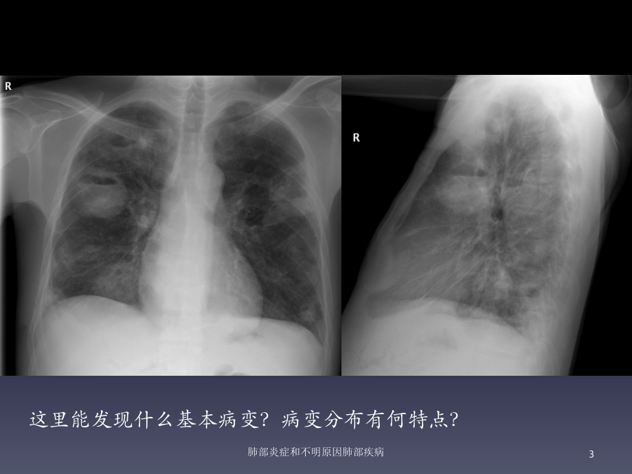 肺部炎症和不明原因肺部疾病培训课件.ppt_第3页