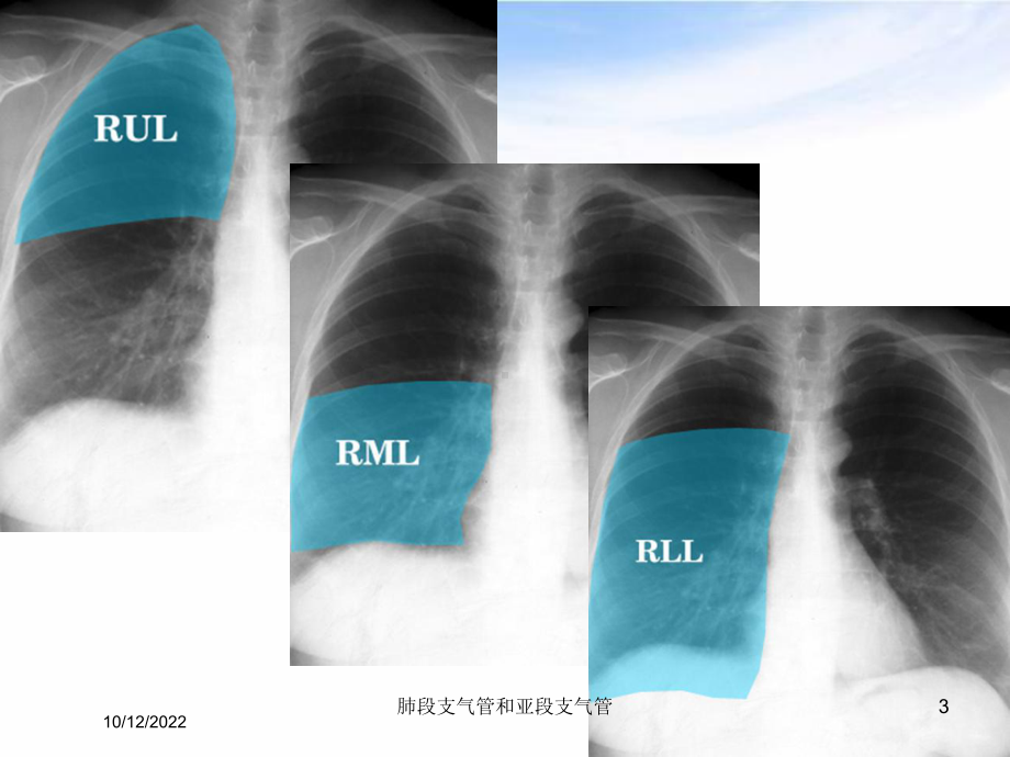 肺段支气管和亚段支气管培训课件.ppt_第3页