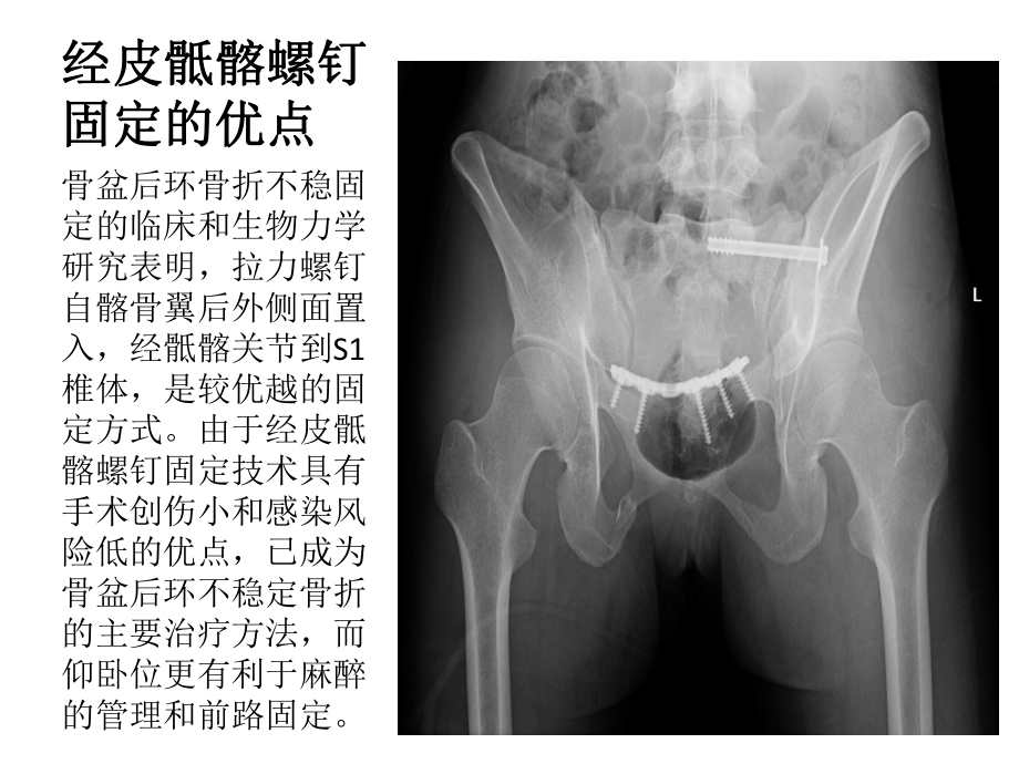 仰卧位C臂透视下经皮骶髂螺钉固定治疗骶髂关节损伤概要课件.ppt_第2页