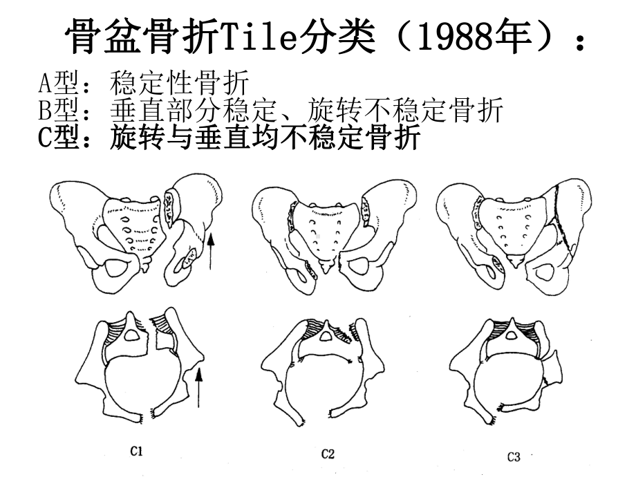 仰卧位C臂透视下经皮骶髂螺钉固定治疗骶髂关节损伤概要课件.ppt_第3页