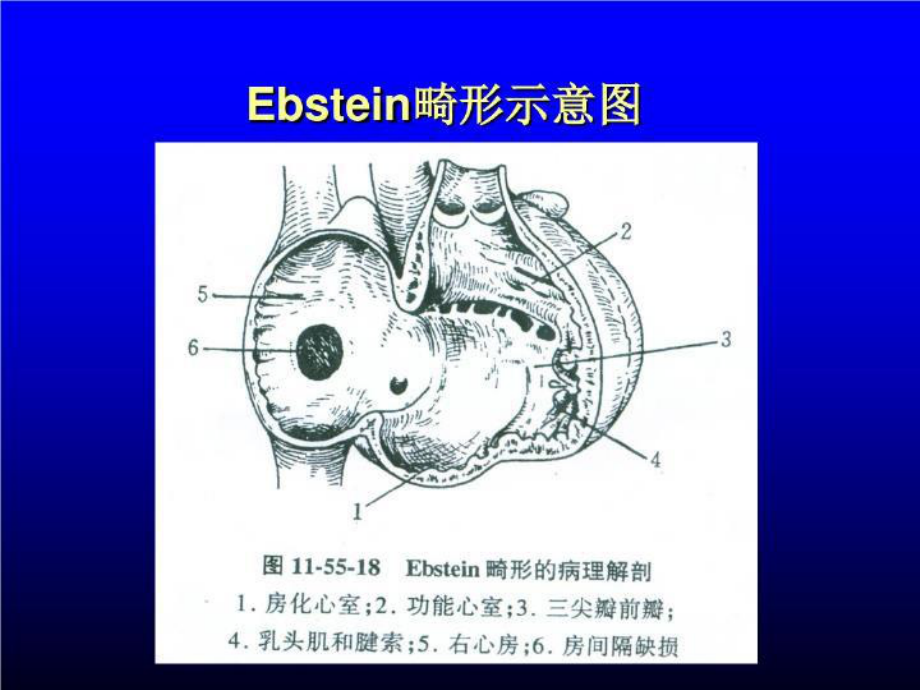 三尖瓣下移畸形-ebstein-anomaly课件.ppt_第3页