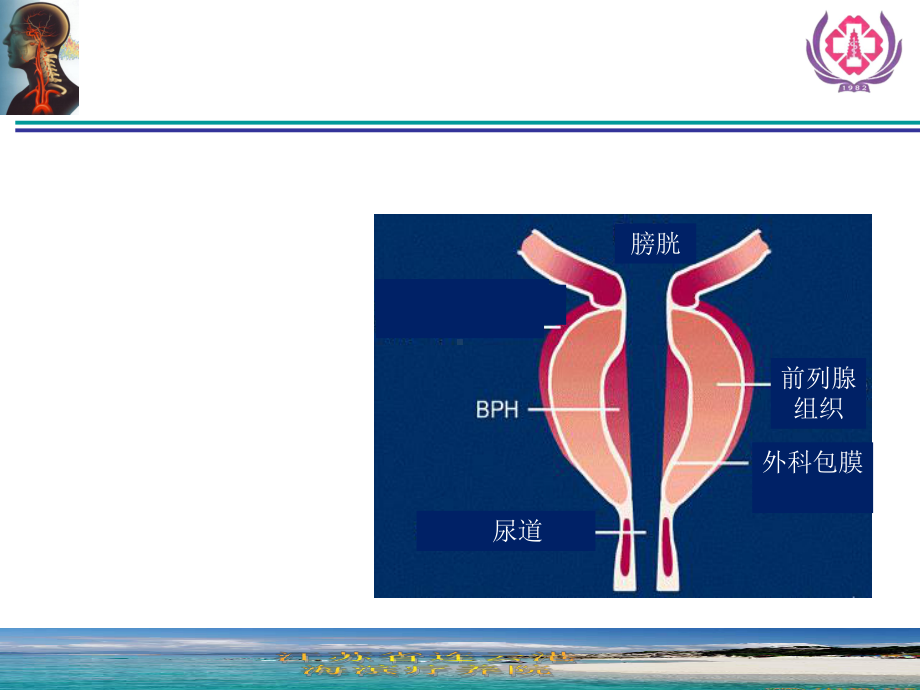 前列腺增生症诊断治疗概论课件.ppt_第3页