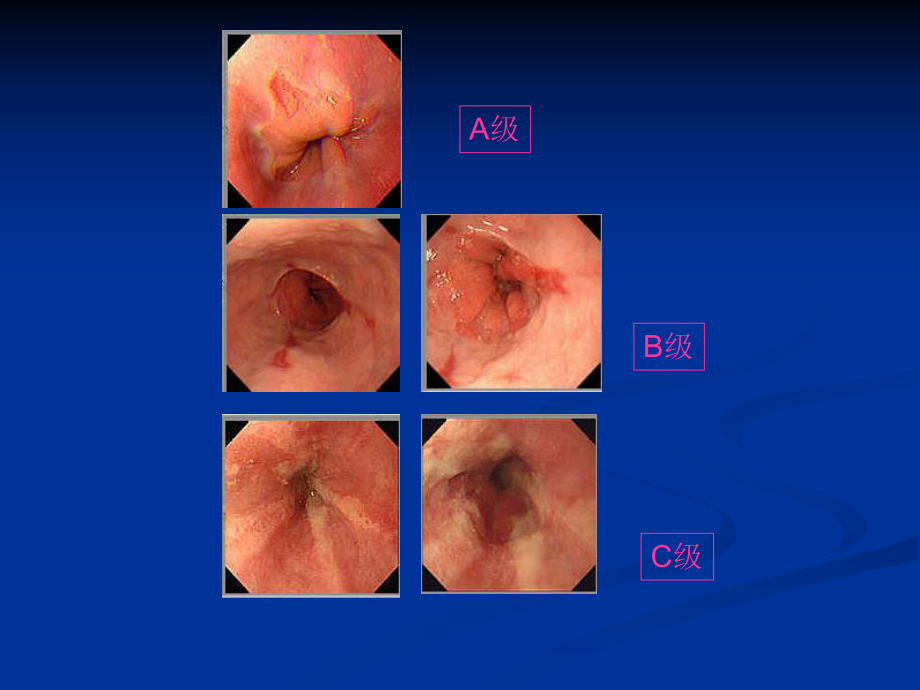 上消化道内镜诊断规范课件-2.ppt_第3页