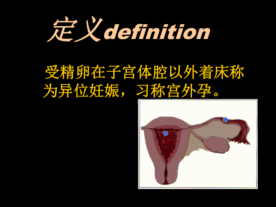 《异位妊娠》课件.ppt_第2页