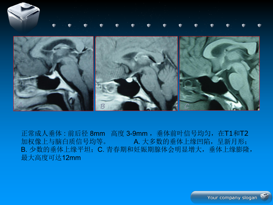 垂体微腺瘤影像和治疗策略课件.ppt_第2页