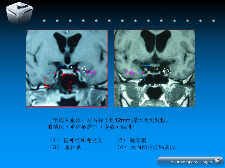 垂体微腺瘤影像和治疗策略课件.ppt_第3页