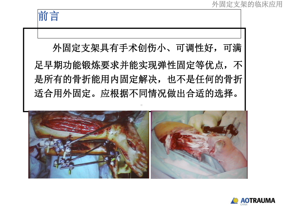 外固定支架的临床应用参考课件.ppt_第3页