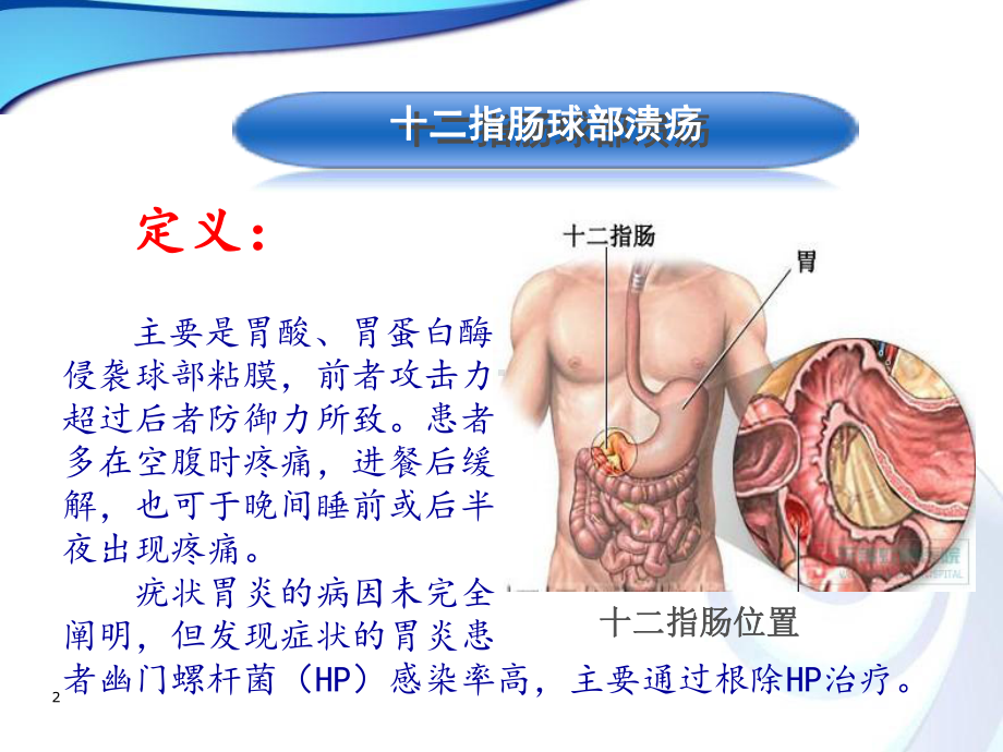 十二指肠球部溃疡(课堂)课件.ppt_第2页