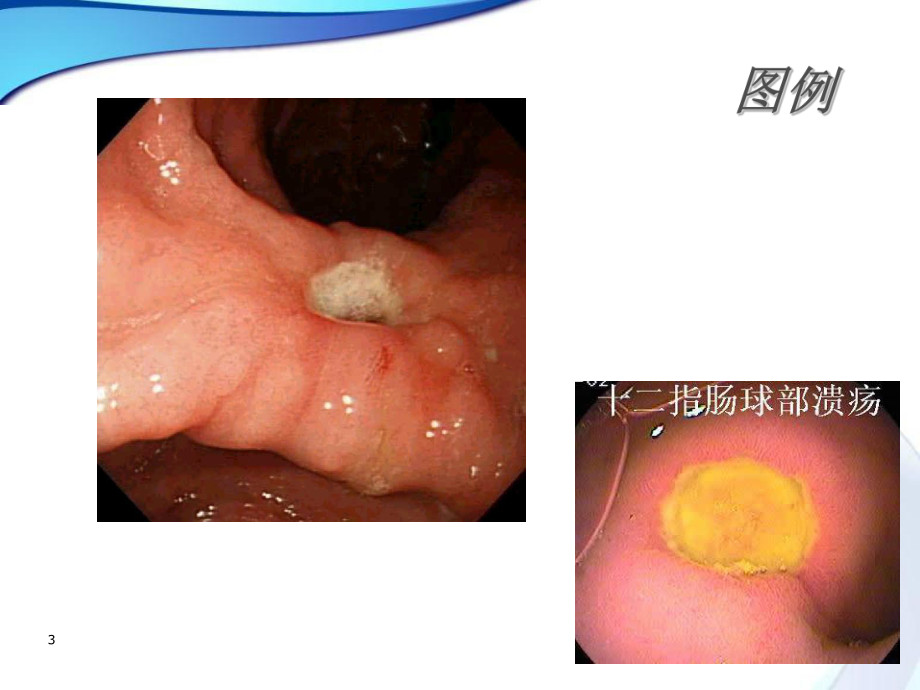 十二指肠球部溃疡(课堂)课件.ppt_第3页