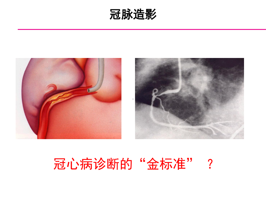 冠脉介入新技术课件.ppt_第3页