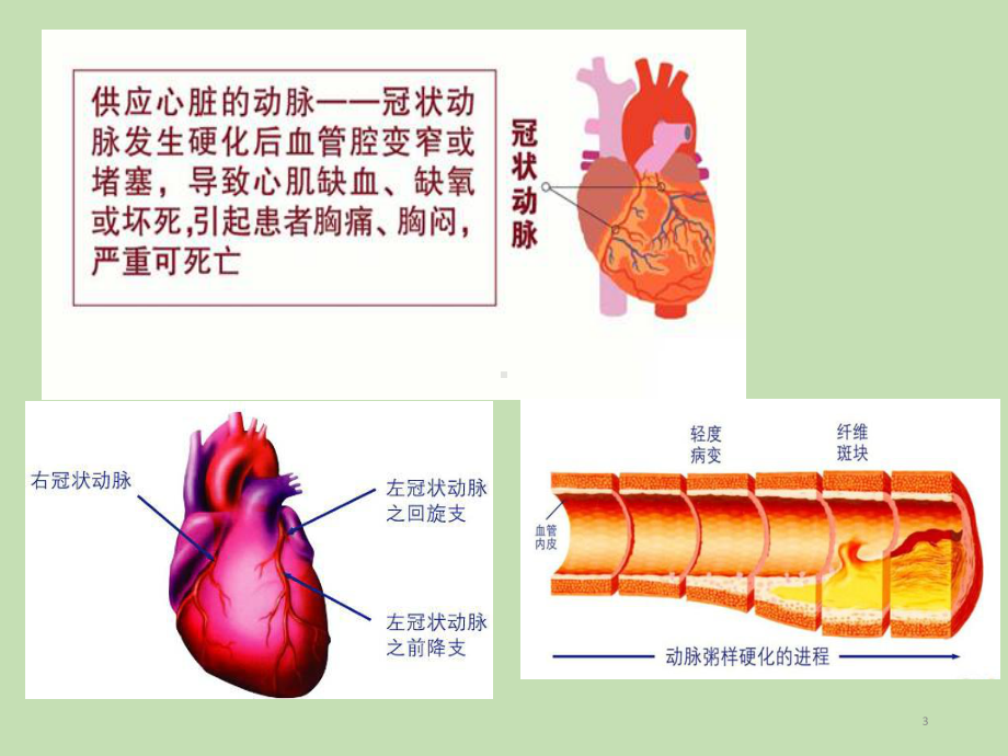 冠心病的诊断与治疗参考课件.ppt_第3页