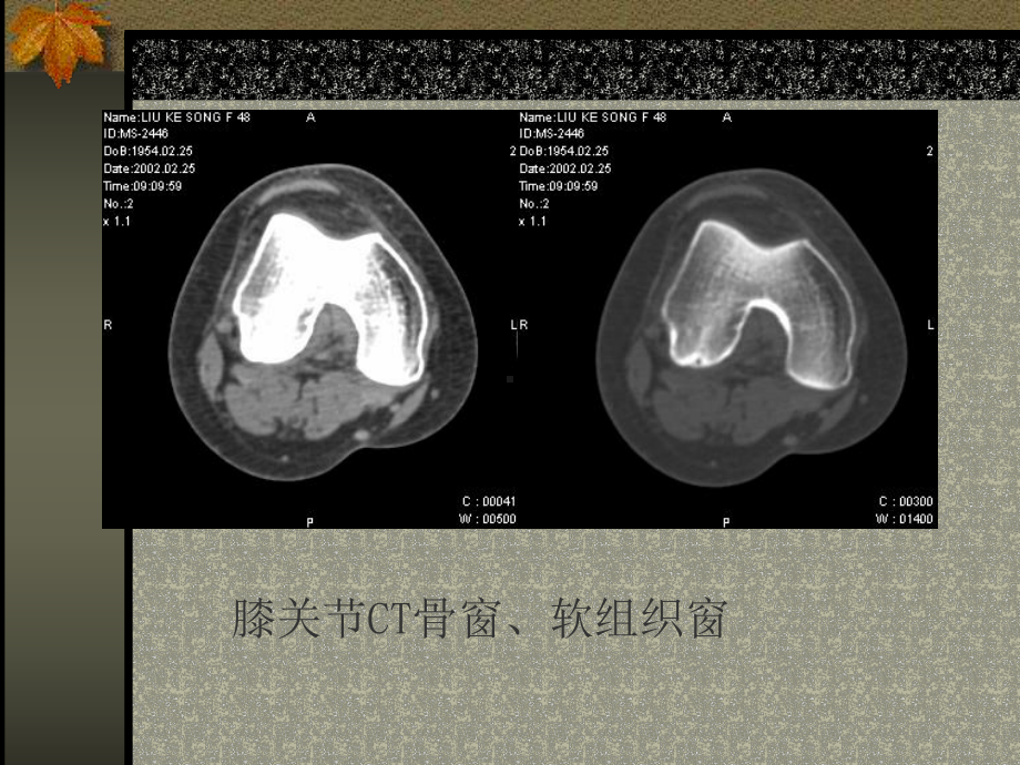 医学影像学：肌、骨与关节系统课件.ppt_第3页