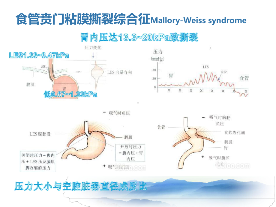 上消化道出血少见病因课件.ppt_第3页