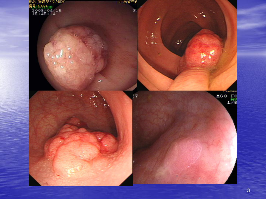 内镜下息肉治疗医学课件.ppt_第3页
