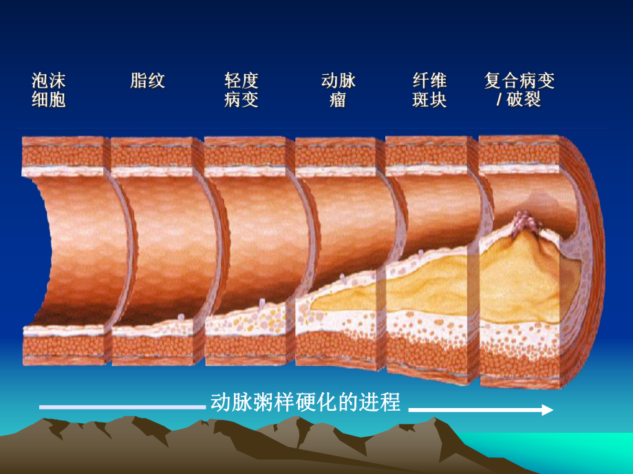 冠心病诊断及治疗指导课件.ppt_第3页