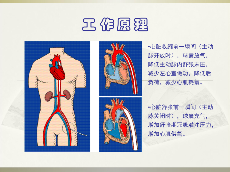 哈医大四院IABP总汇课件.ppt_第3页