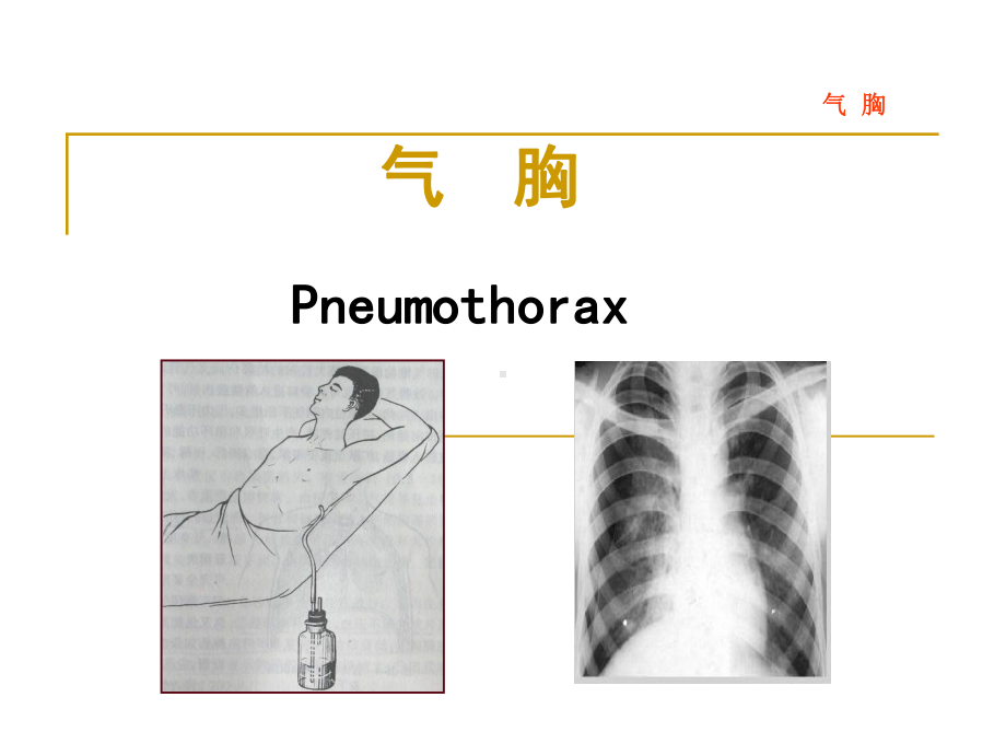 医学课件：气胸血胸.ppt_第2页