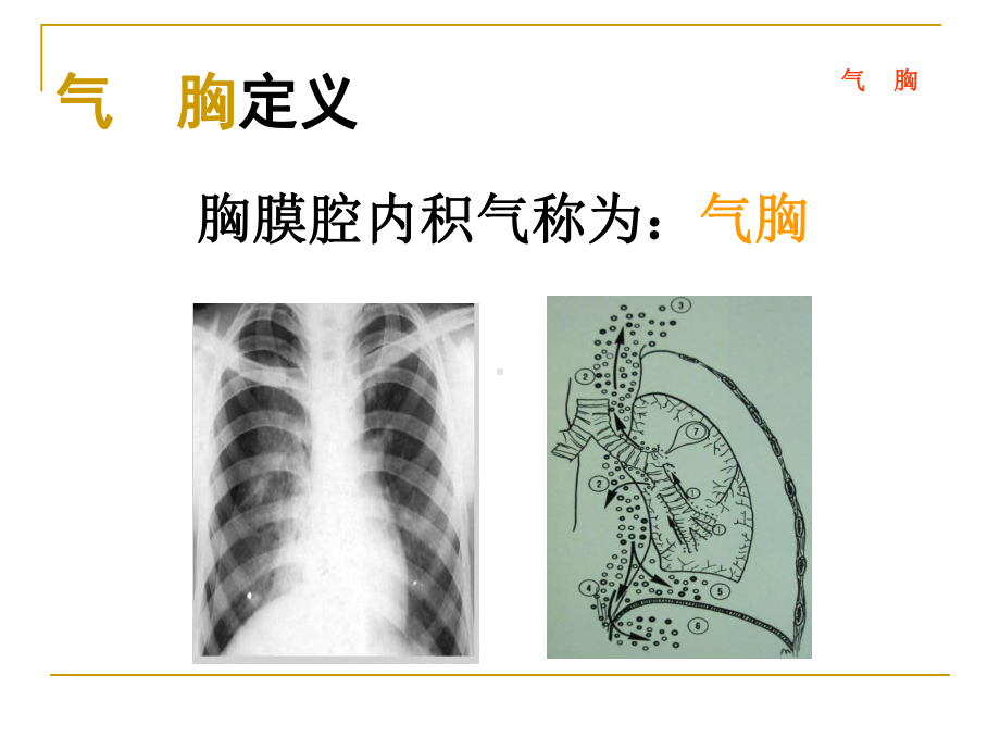 医学课件：气胸血胸.ppt_第3页