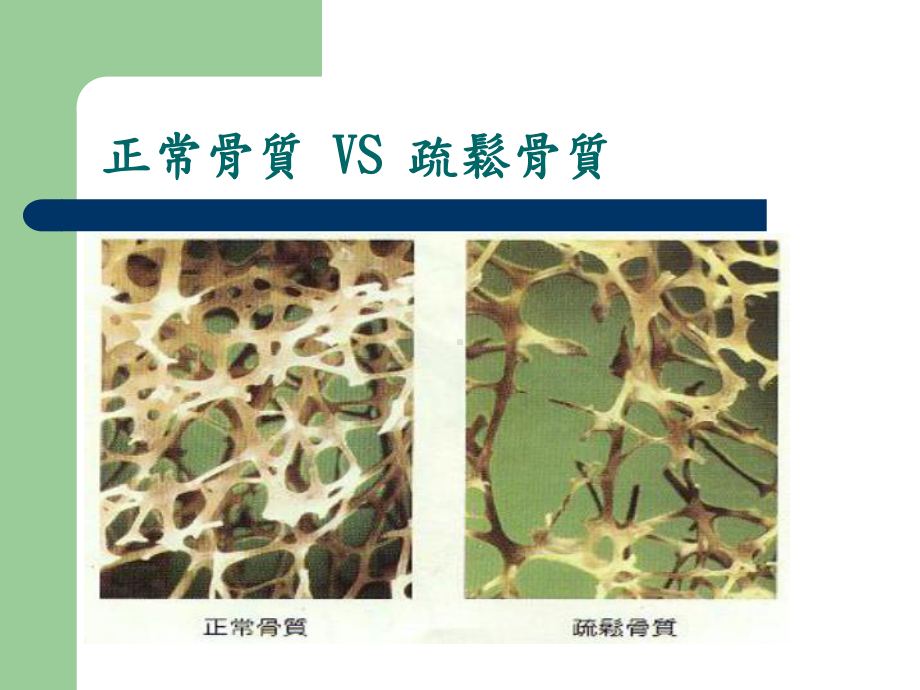 别让骨质疏松症悄悄上身课件.ppt_第3页