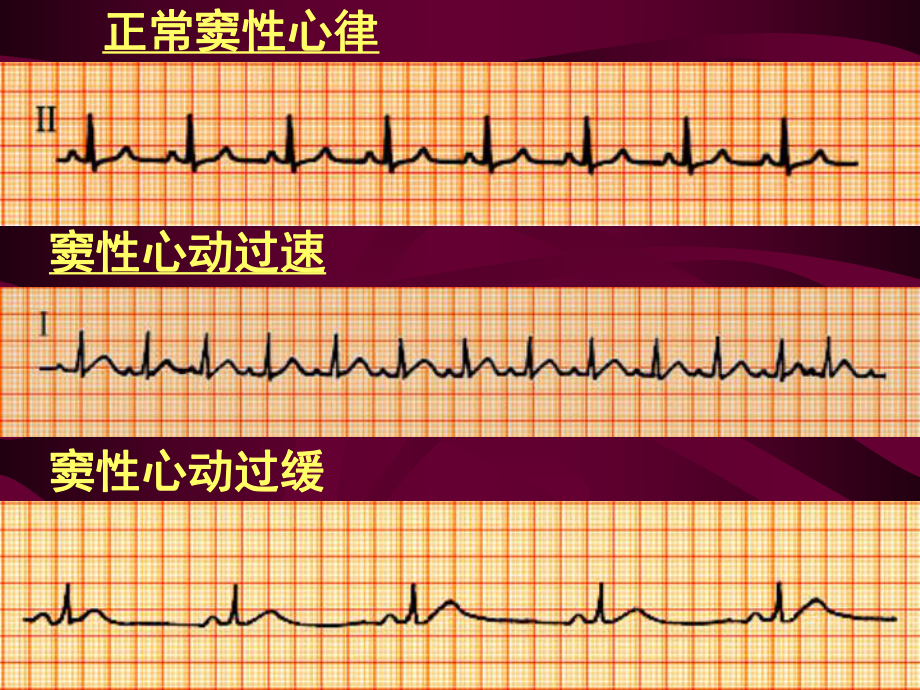 《心电图讲课》课件.ppt_第2页